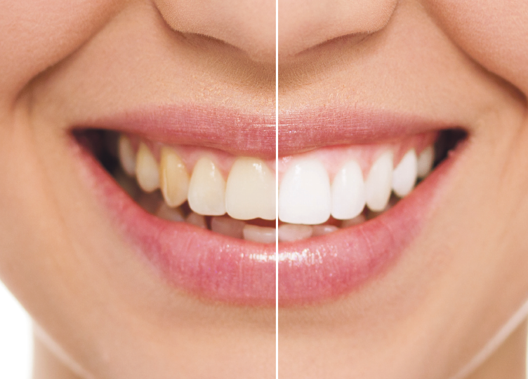 A woman's smile improved by teeth whitening and bonding.