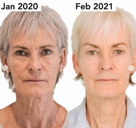 Before and after picture illustrating Judy Murray's Morpheus8 transformation.
