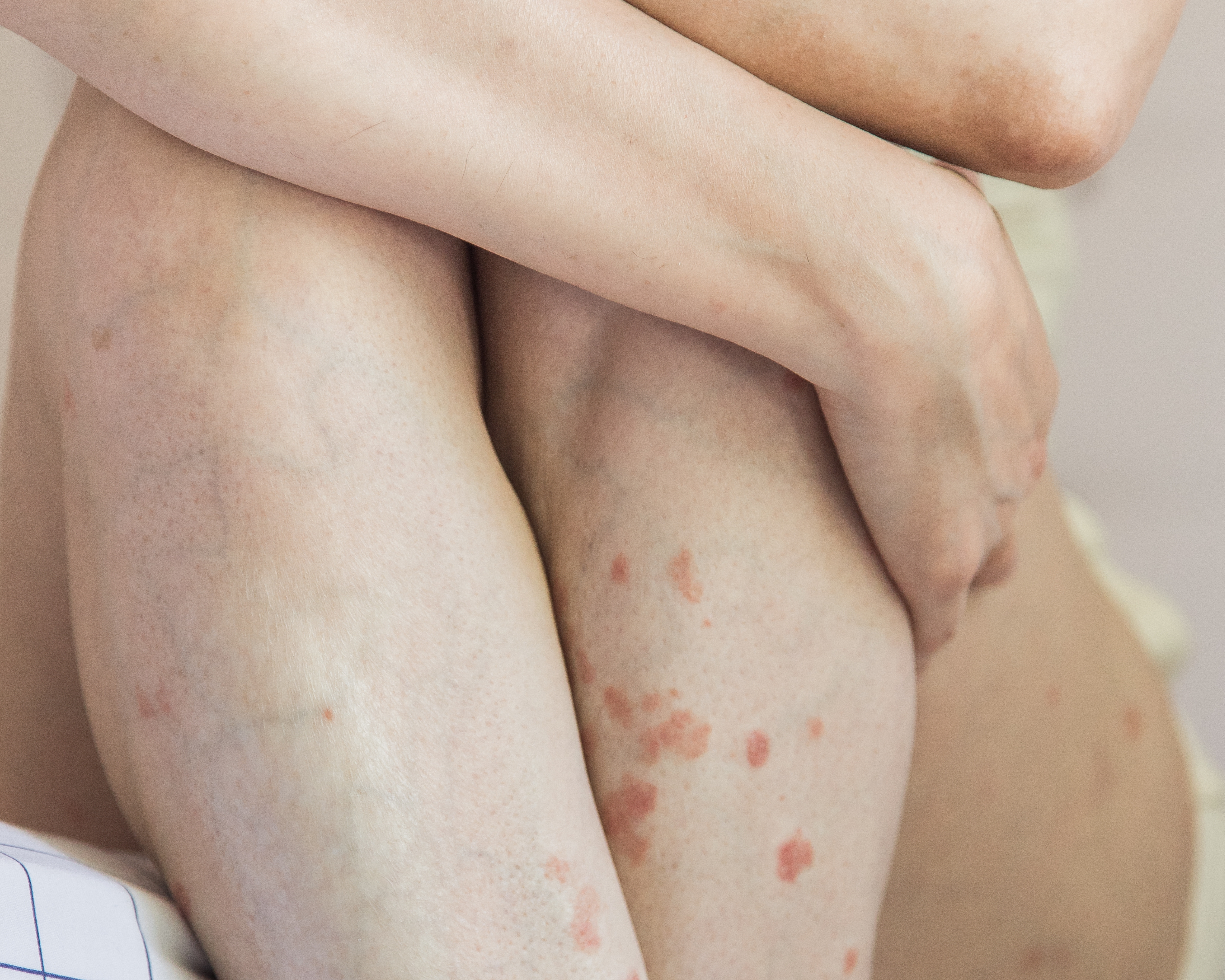 Image of a woman with psoriasis covering legs