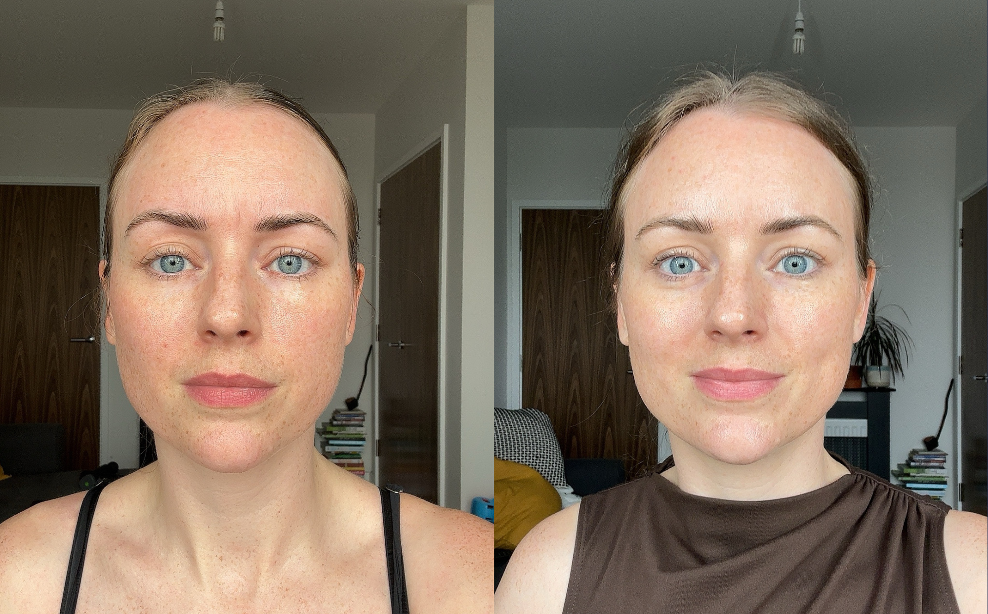 Two protrait photos of a woman side by side, one taken before forehead botox and brow lift, and one after