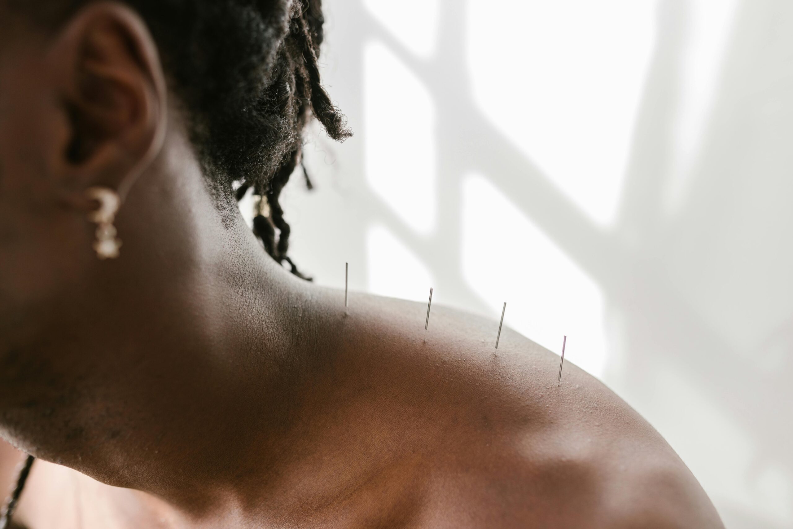 acupuncture needles in a woman's shoulder