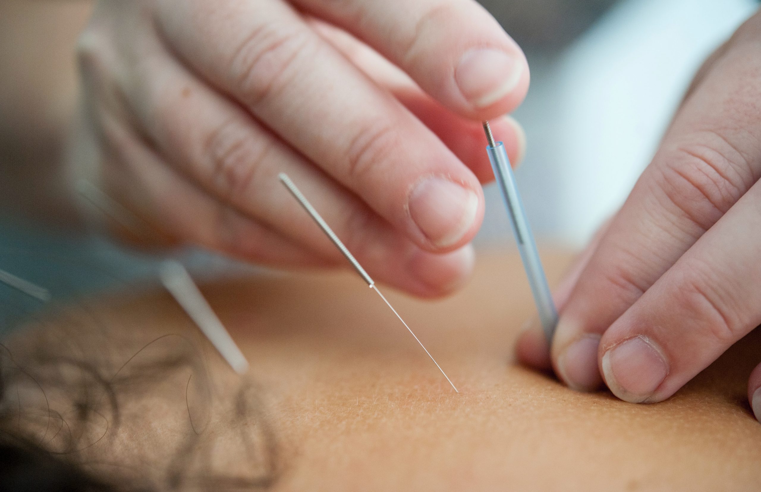 Applying the needles in acupuncture. 