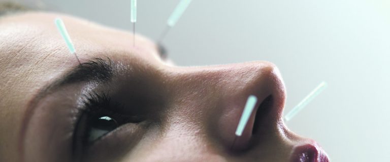 A woman undergoes facial acupuncture to tone the muscles in her face.