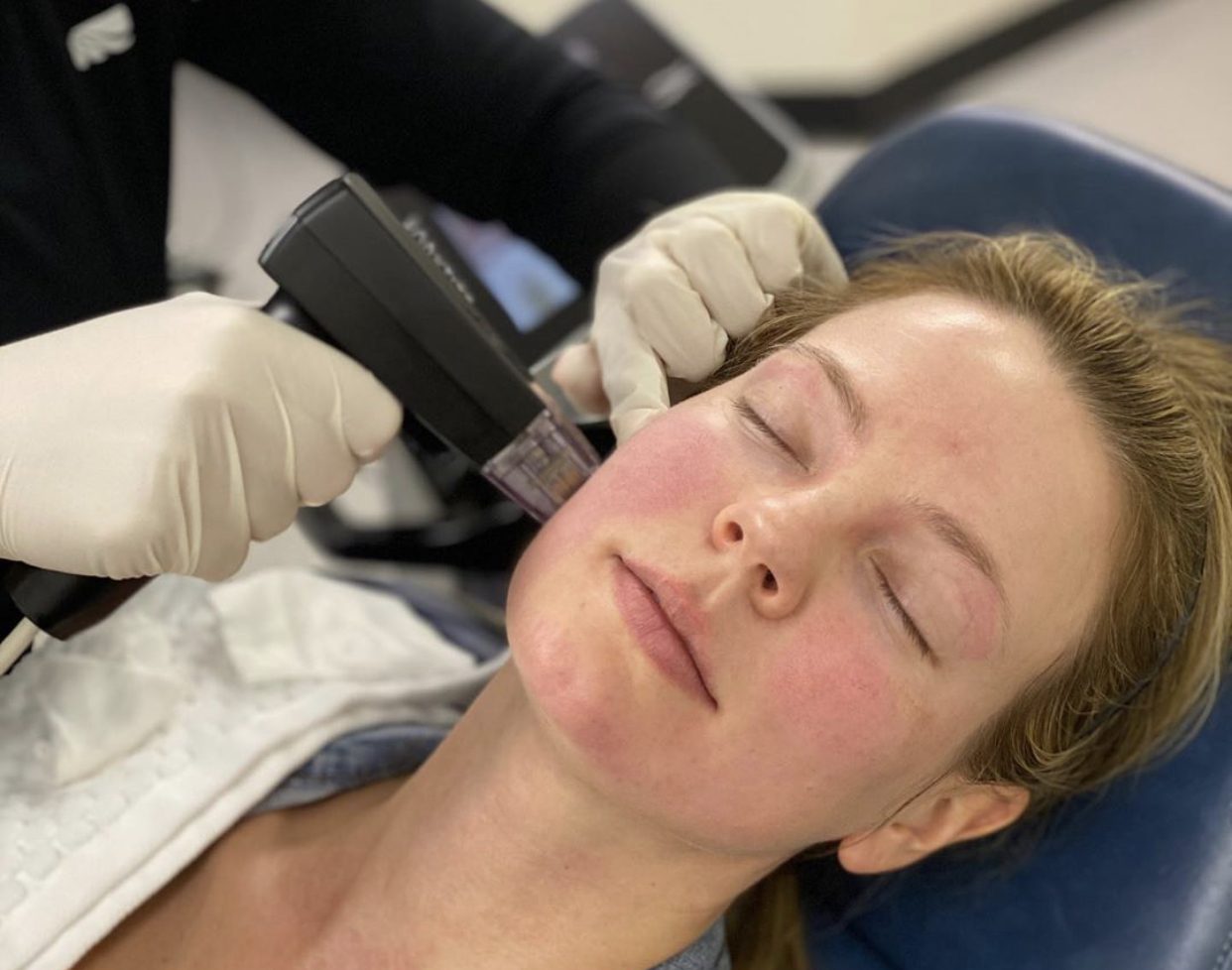 A woman undergoing the Morpheus8 treatment