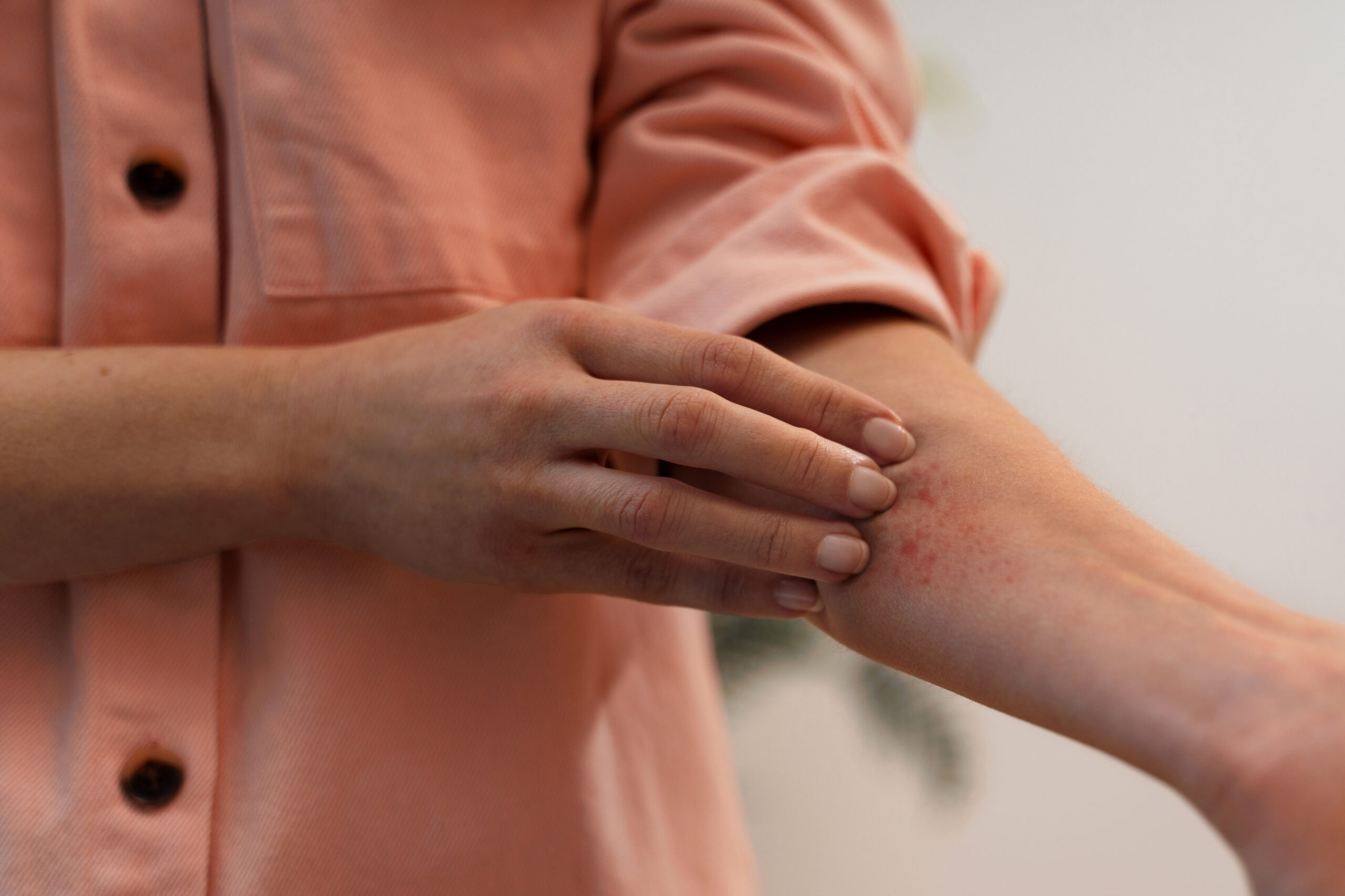 Woman scratched her eczema