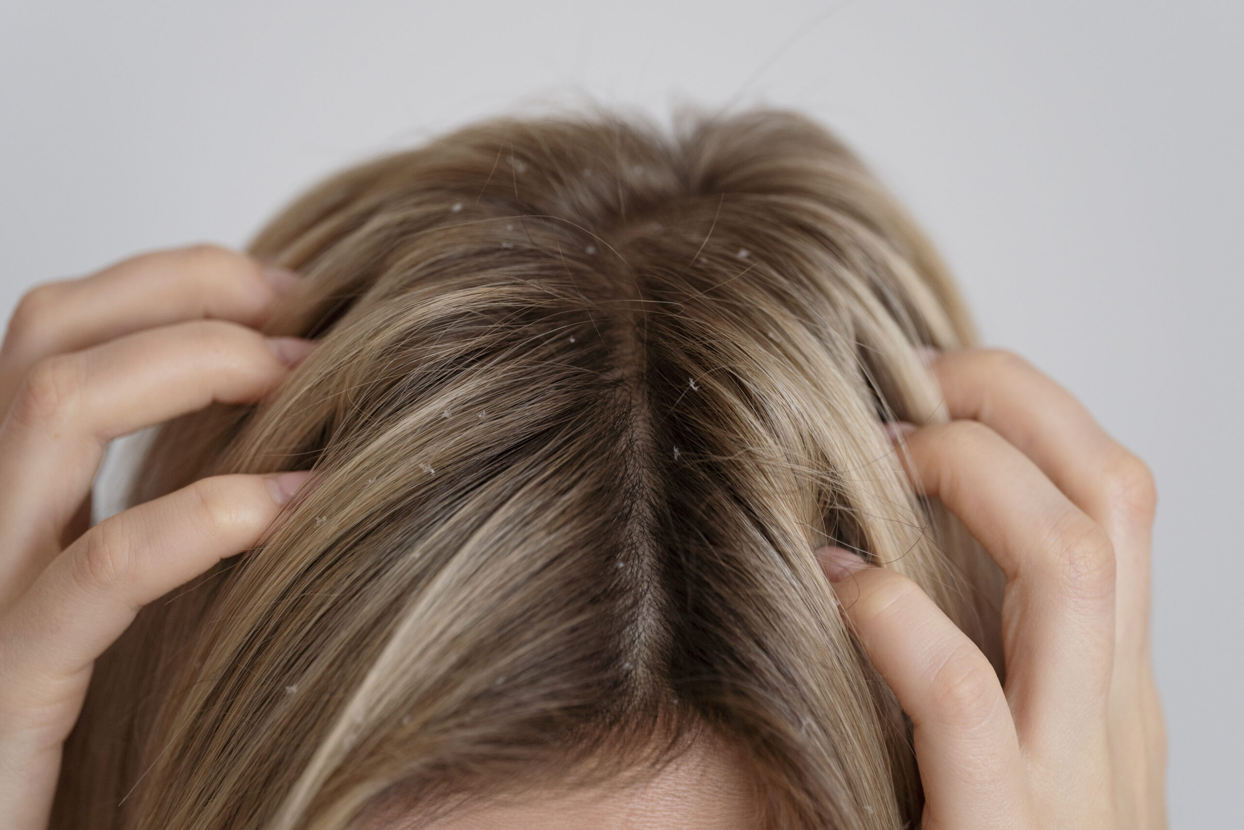 Woman with a flaky scalp