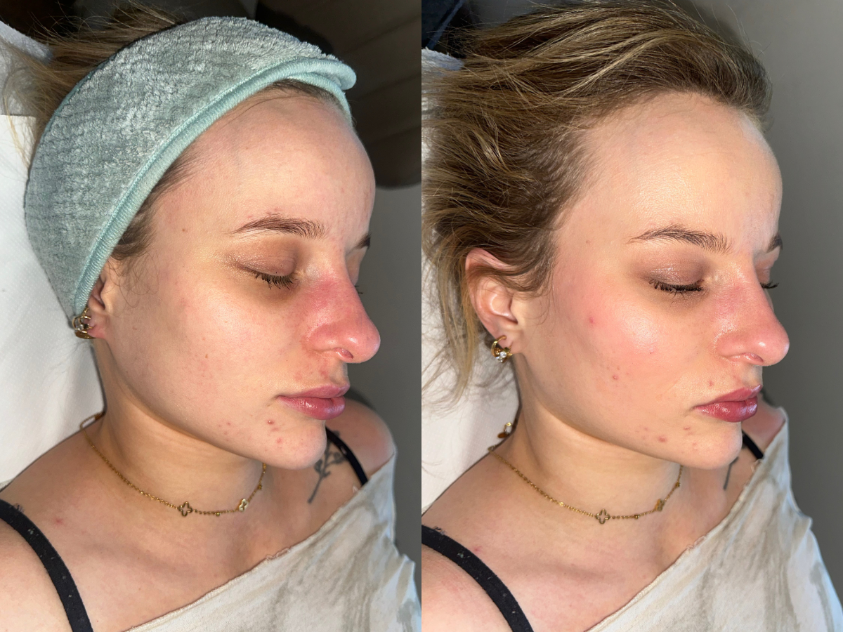 Layla before and after BB Glow treatment