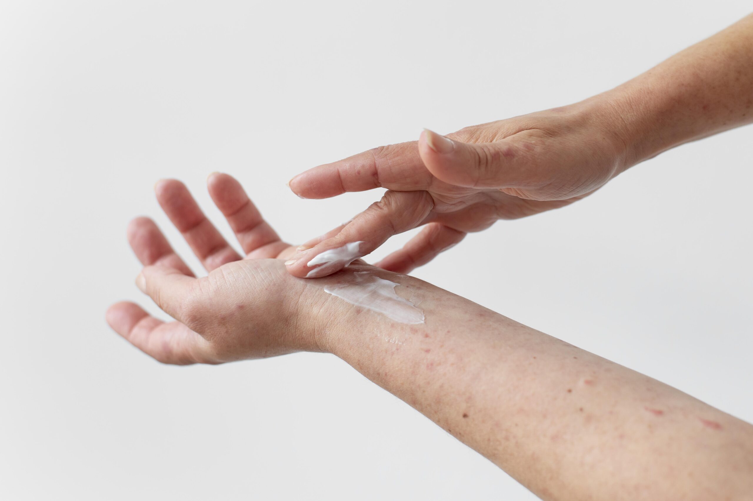 Woman with eczema applying lotion