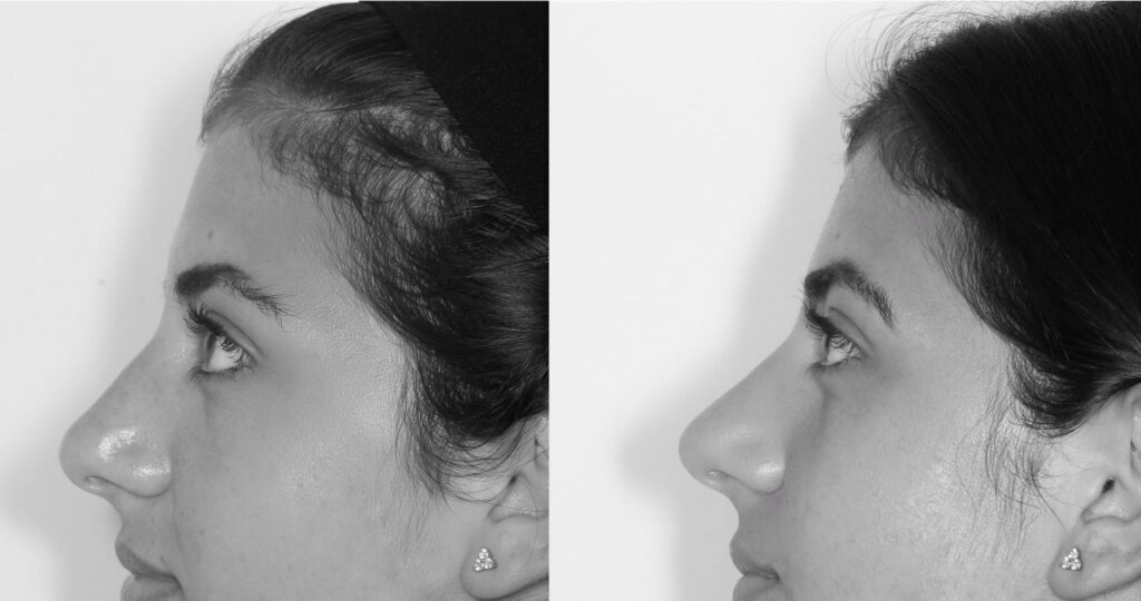 Side by side profile photo of the same woman showing before and after results of non-surgical rhinoplasty