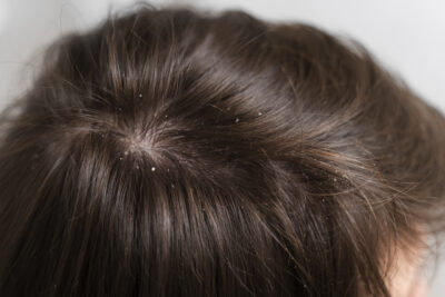 Close up picture of brunette haired woman with flaky scalp