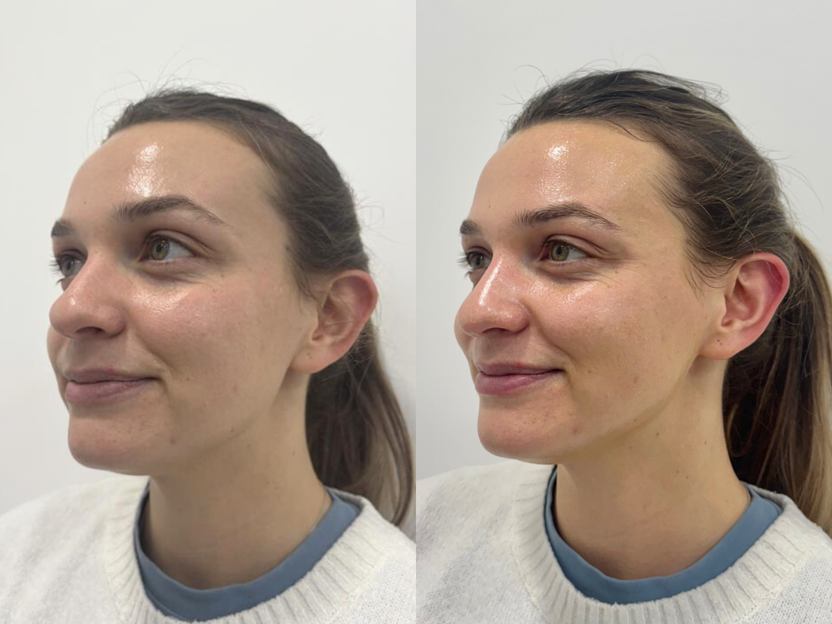 Evelyn Richards before and after the Glass Skin Peel