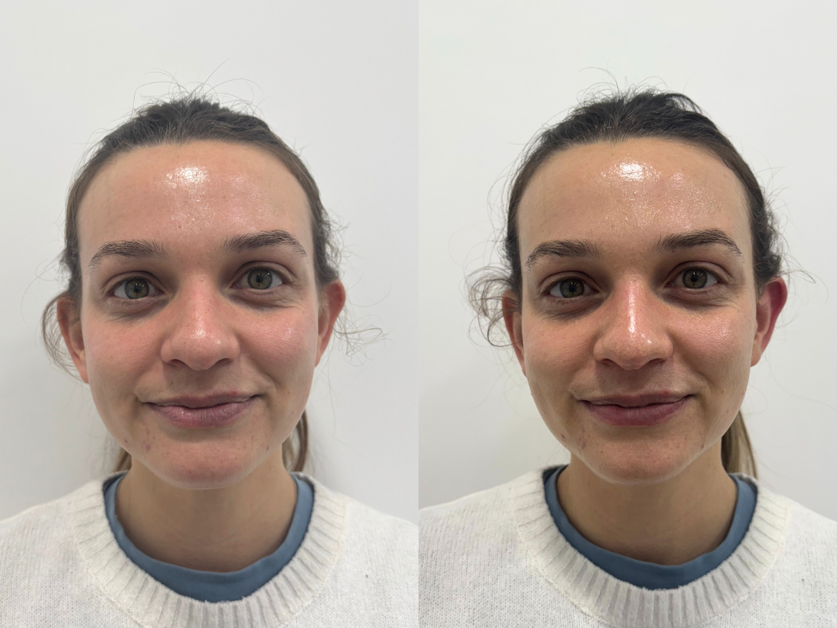 Evelyn Richards before and after the Glass Skin Peel