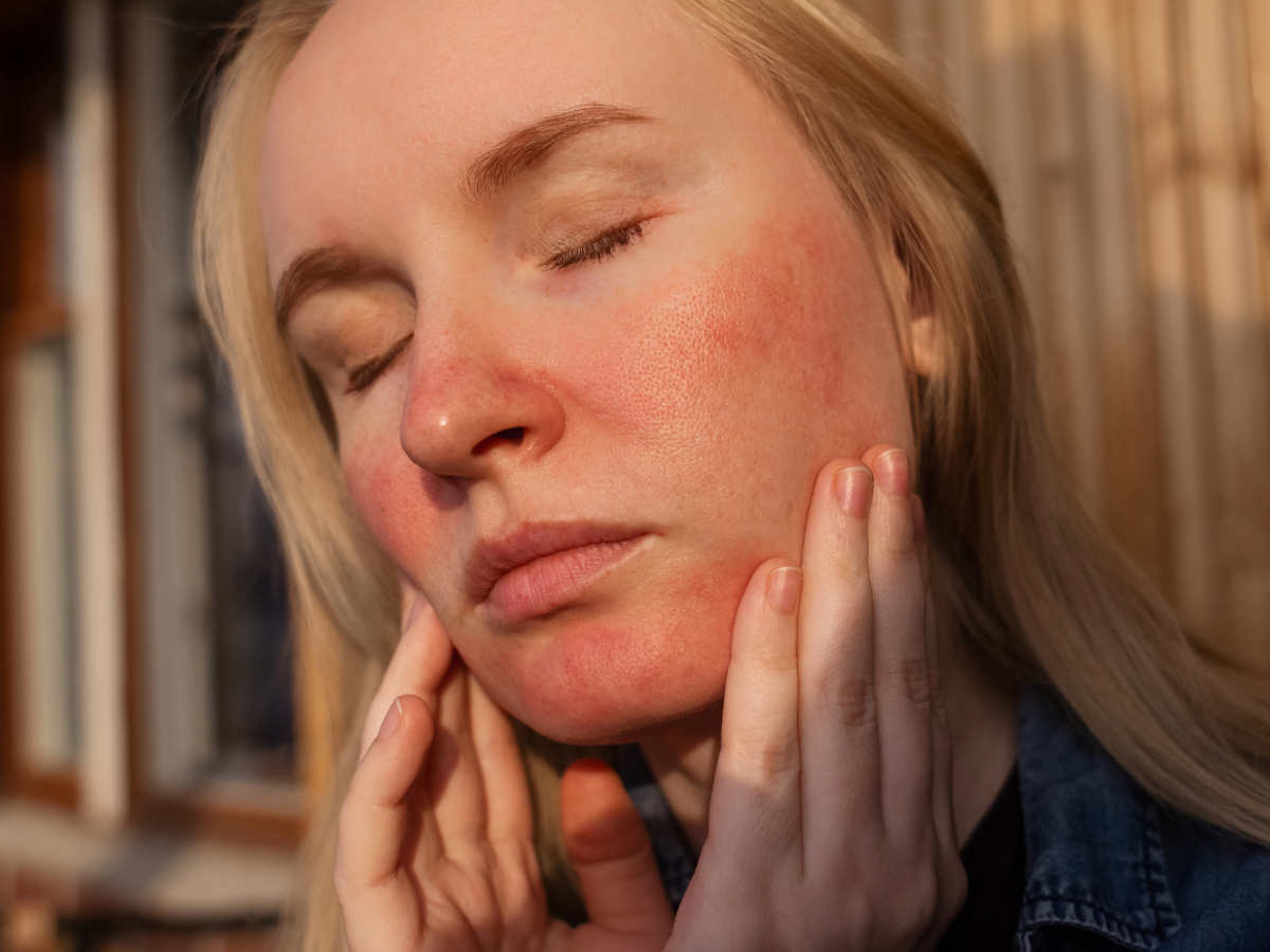 Woman with rosacea