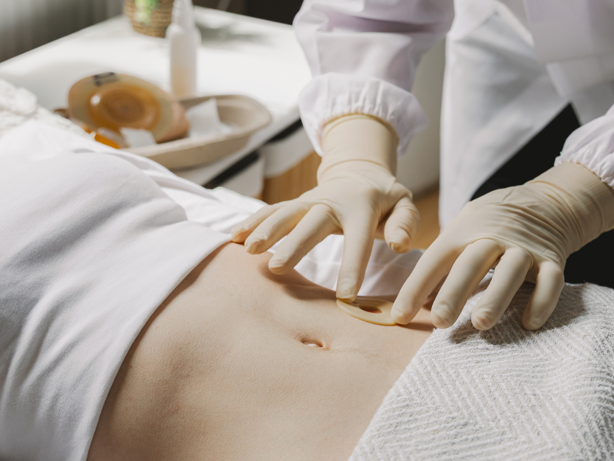 Woman gets stoma inserted