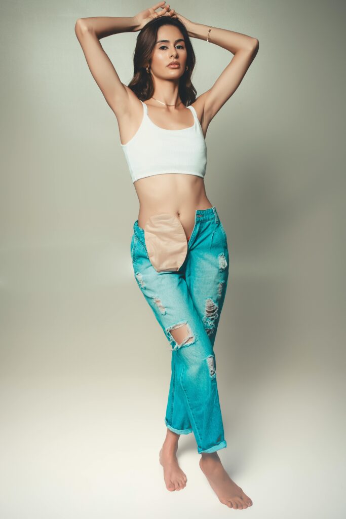 Woman poses with a stoma